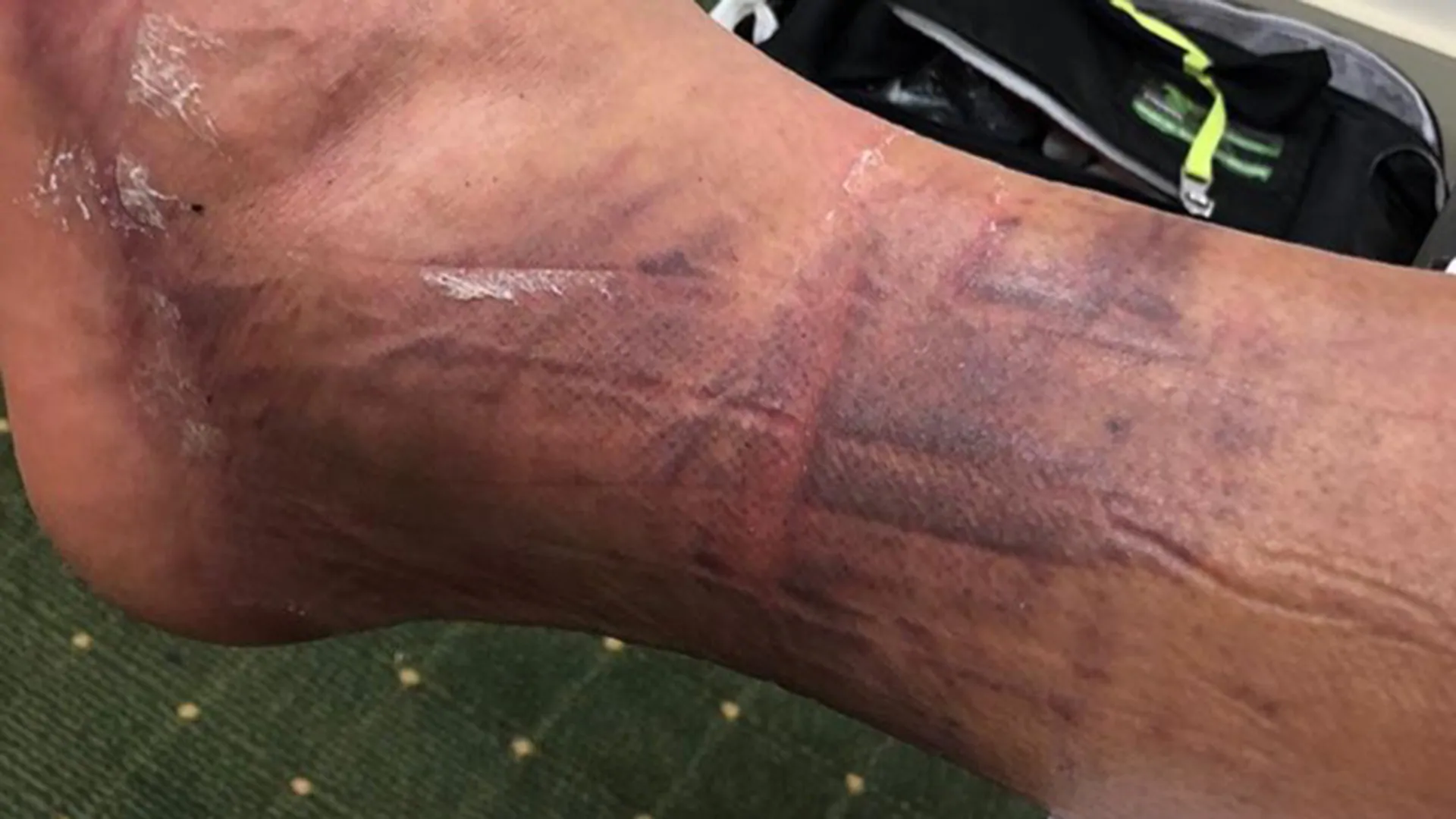 Photos: Finau shows off injured, purple ankle