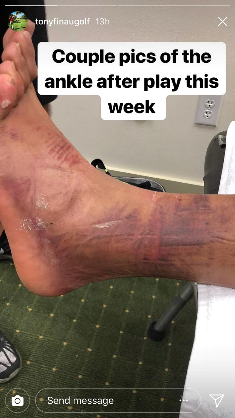 Photos: Finau shows off injured, purple ankle